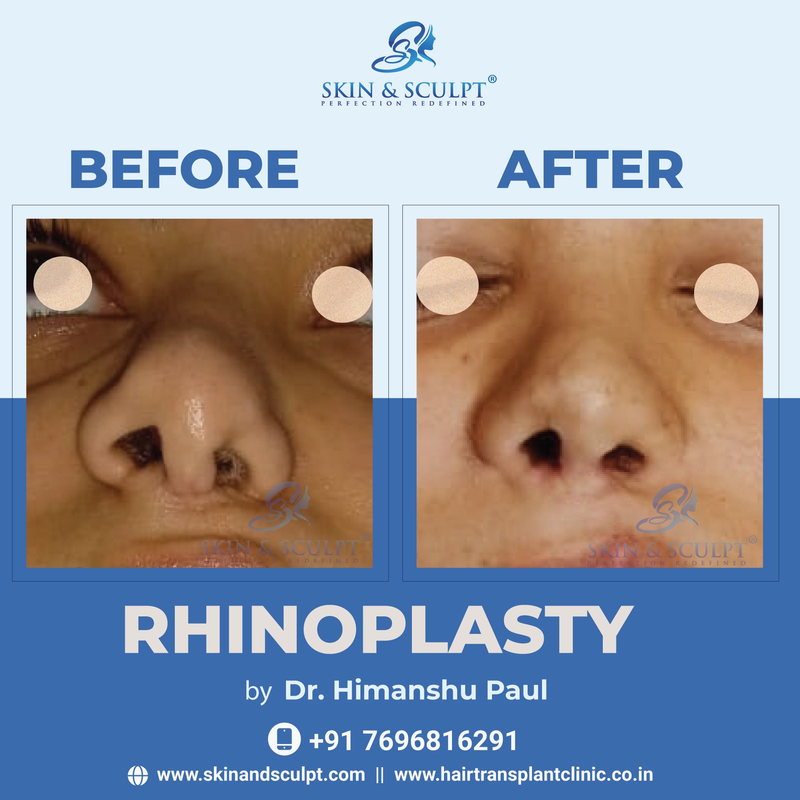 Rhinoplasty in Chandigarh By Dr. Himanshu Paul (Skin and Sculpt)