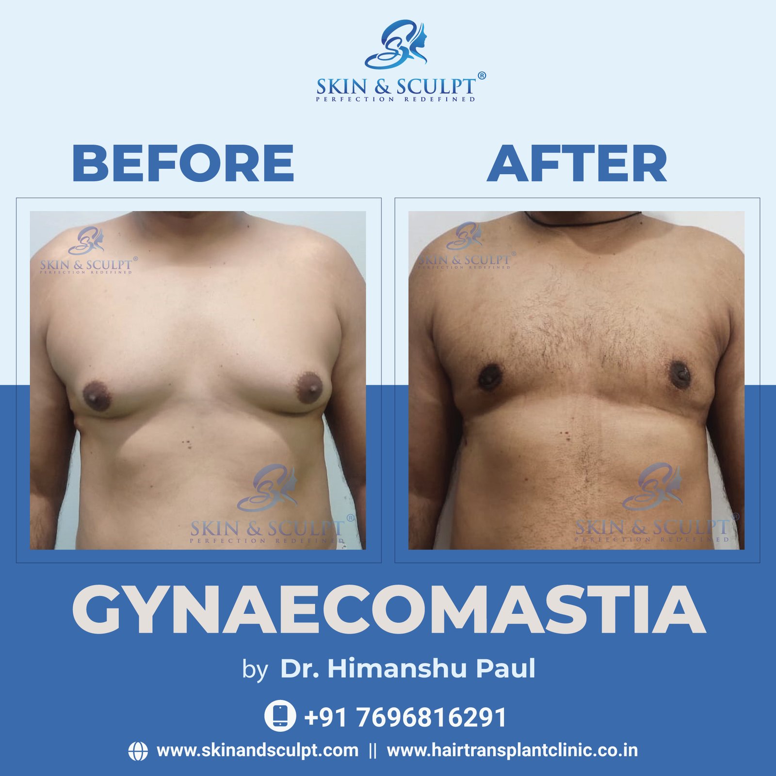 Gynecomastia In Chandigarh By Dr. Himanshu Paul