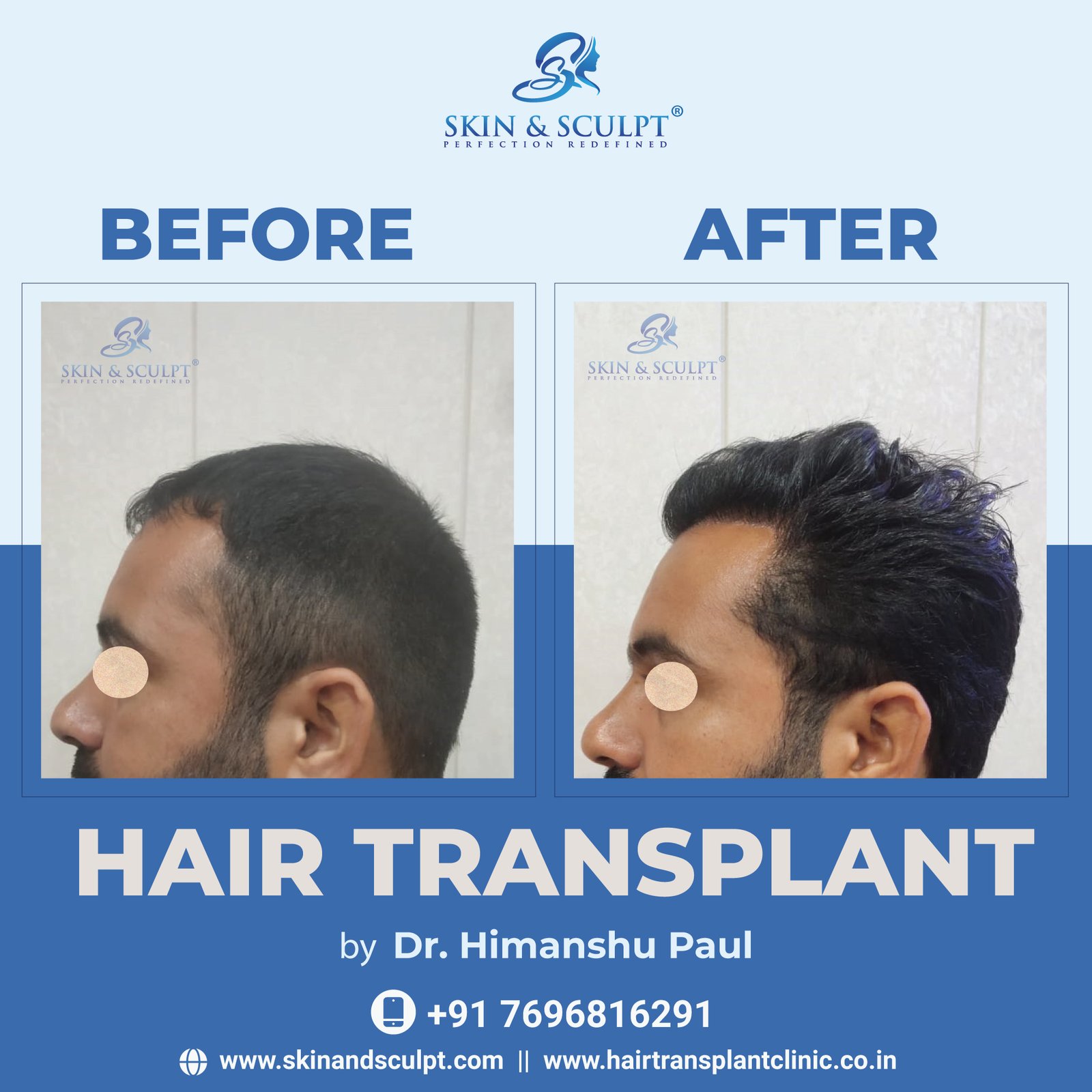 Hair Transplant In Chandigarh By Dr. Himanshu Paul (Skin and Sculpt)