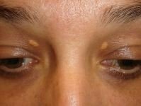 Read more about the article XANTHELASMA
