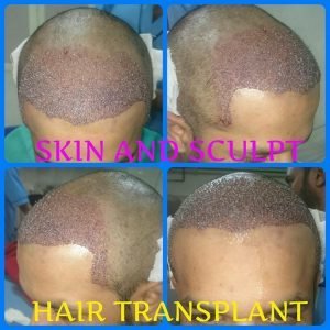 Read more about the article HAIR TRANSPLANT