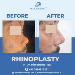 rhinoplasty in chandigarh