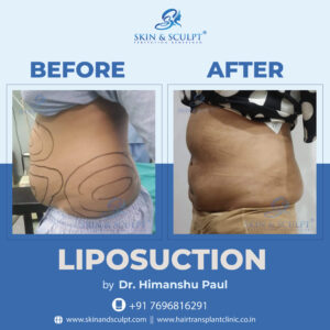 Read more about the article Liposuction Recovery: What to Expect in the Days, Weeks, and Months Following Surgery.