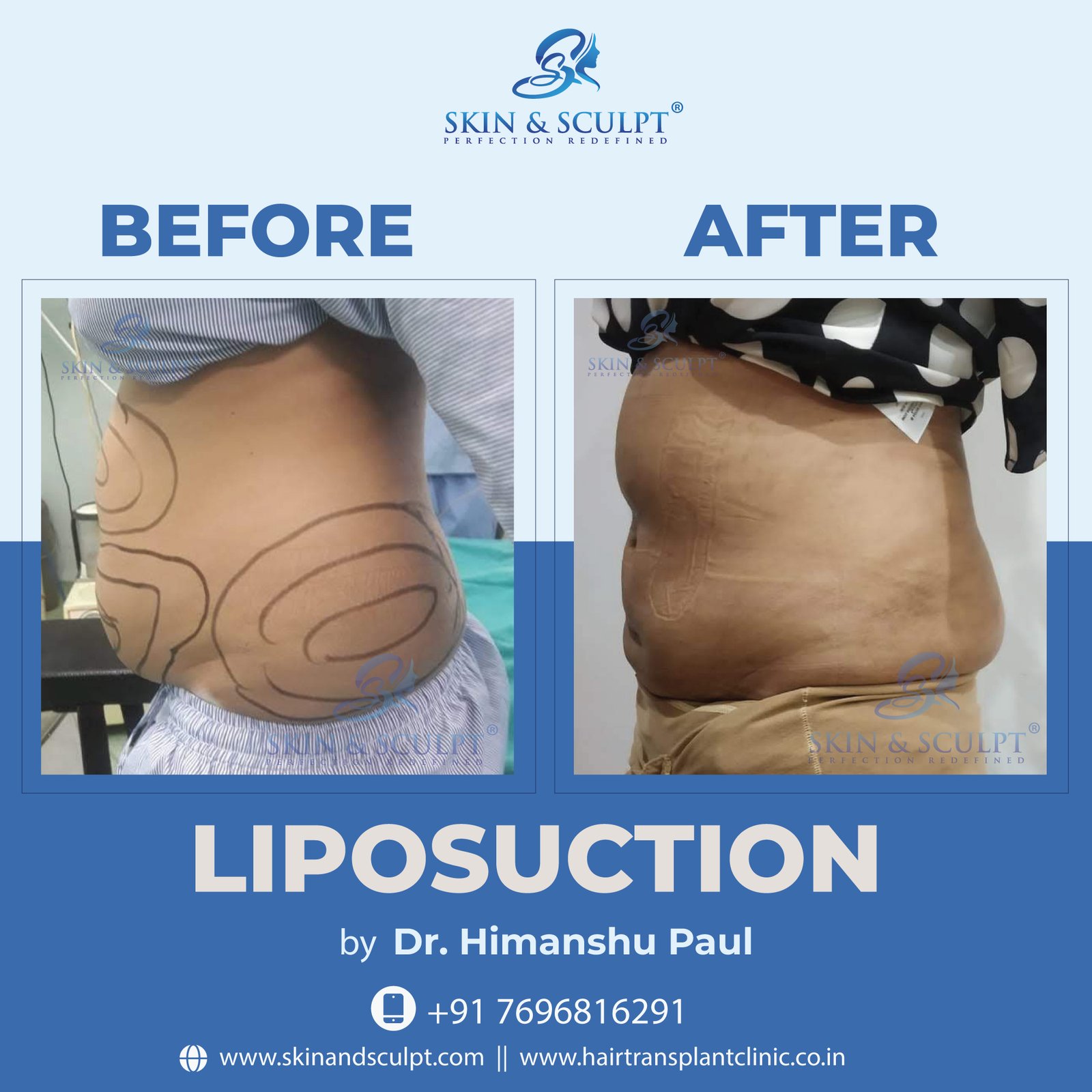 Read more about the article How Liposuction in Chandigarh is Shaping Modern Aesthetics.