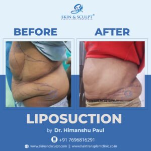 Read more about the article Recovery Tips After Liposuction