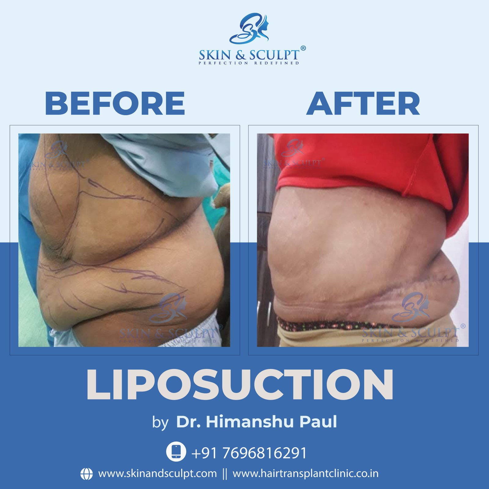 You are currently viewing Recovery Tips After Liposuction