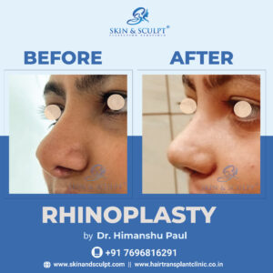 Rhinoplasty in Chandigarh By Dr. Himanshu Paul (Skin and Sculpt)
