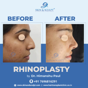 Rhinoplasty in Chandigarh By Dr. Himanshu Paul (Skin and Sculpt)