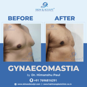 Gynecomastia In Chandigarh By Dr. Himanshu Paul