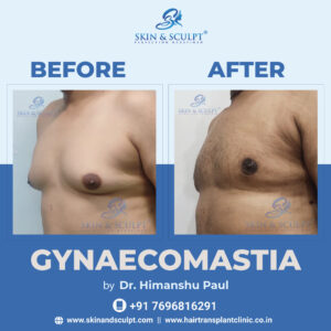 Gynecomastia In Chandigarh By Dr. Himanshu Paul