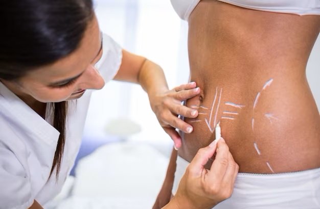 You are currently viewing Is Liposuction Worth It? Find Out Why!