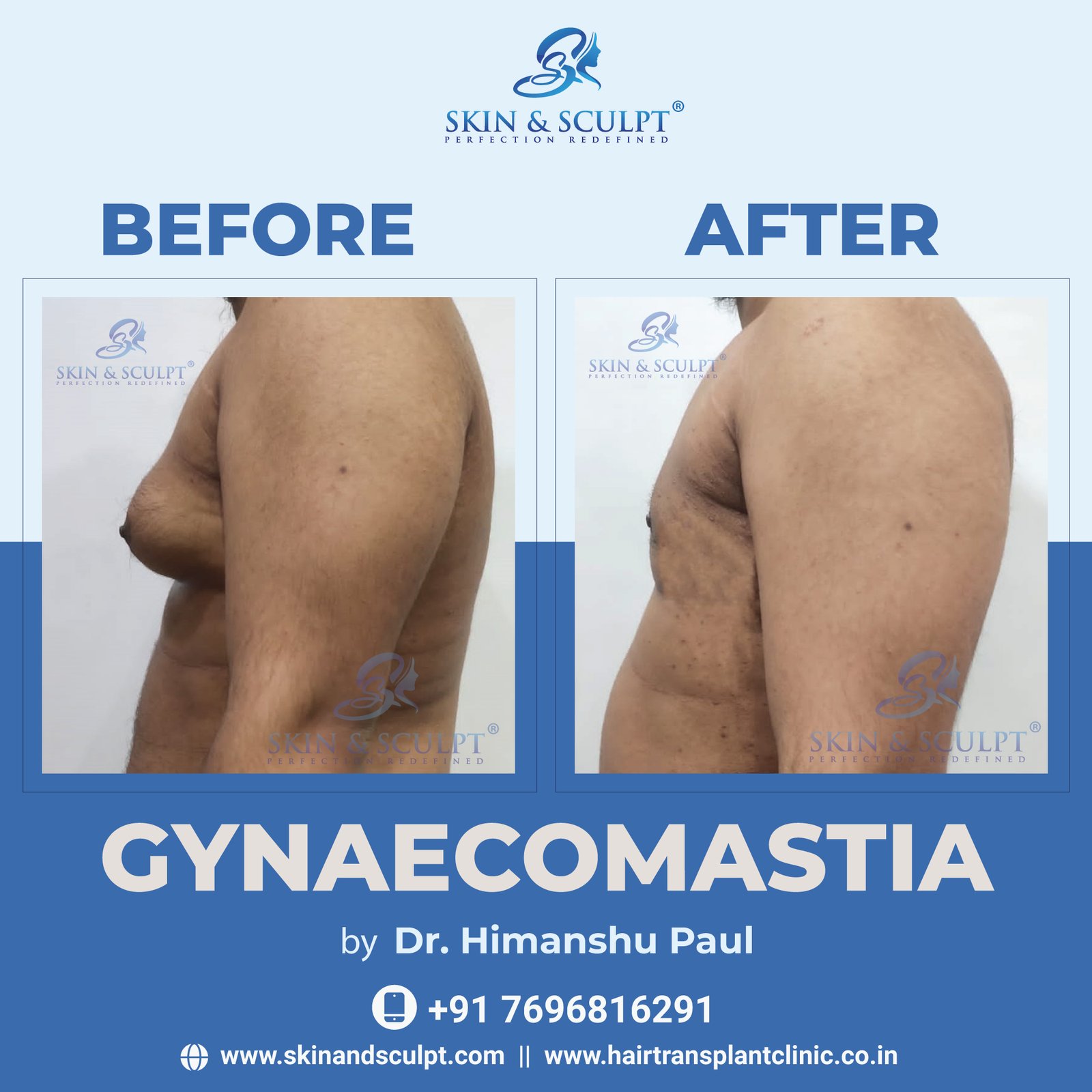 Read more about the article The Top 10 Benefits Of Gynecomastia Surgery