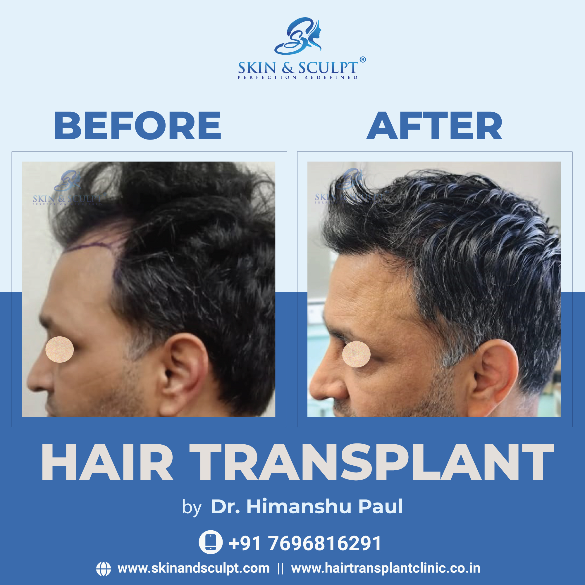 Read more about the article The Hair Transplantation Revolution in Chandigarh