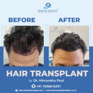 Read more about the article Hair Transplant vs. Other Hair Loss Treatments: Which Is the Right Choice for You?