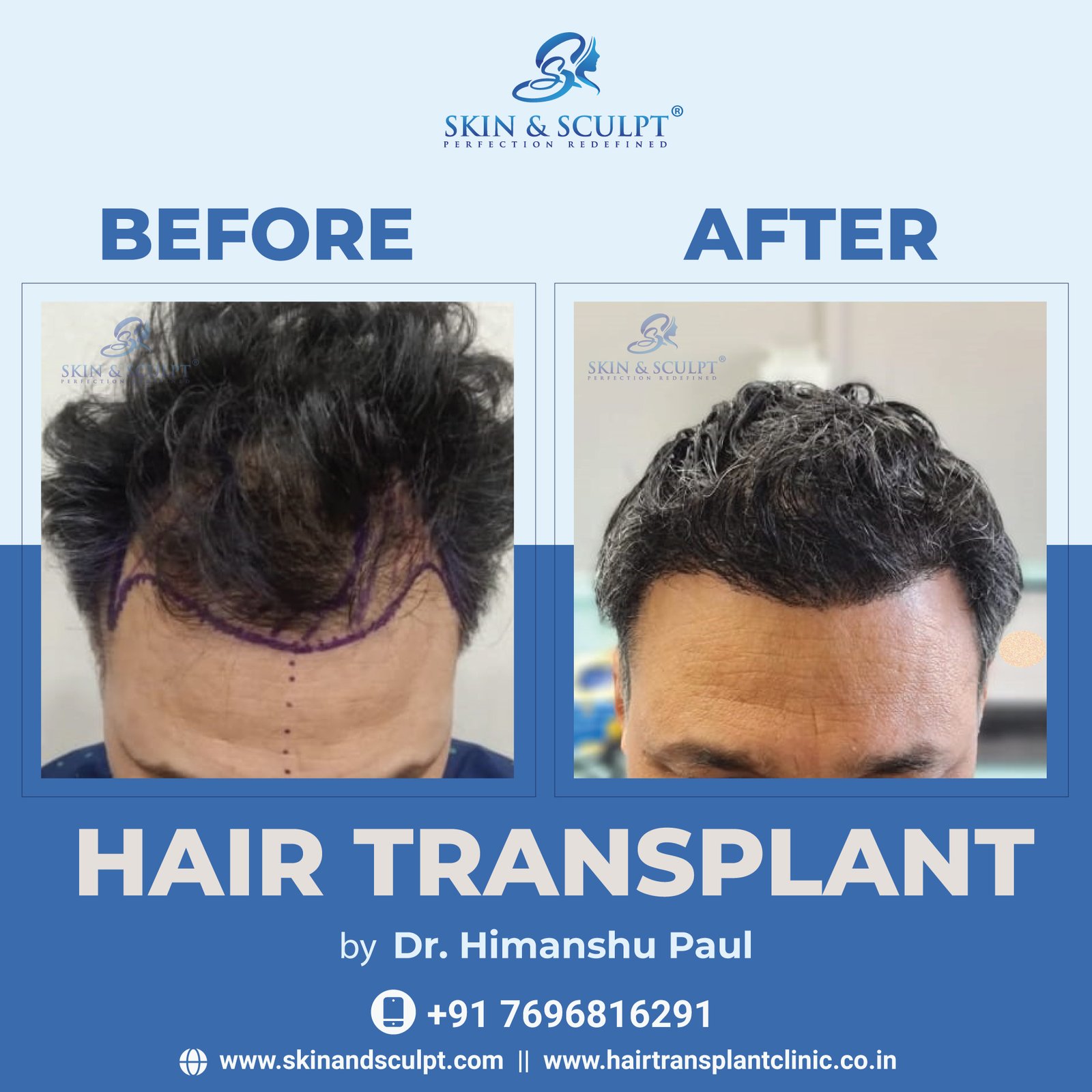 You are currently viewing Hair Transplant vs. Other Hair Loss Treatments: Which Is the Right Choice for You?