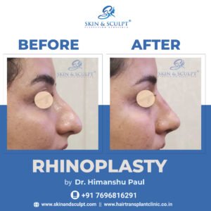 Read more about the article  Rhinoplasty: A Guide to Choosing the Right Surgeon and Understanding the Procedure