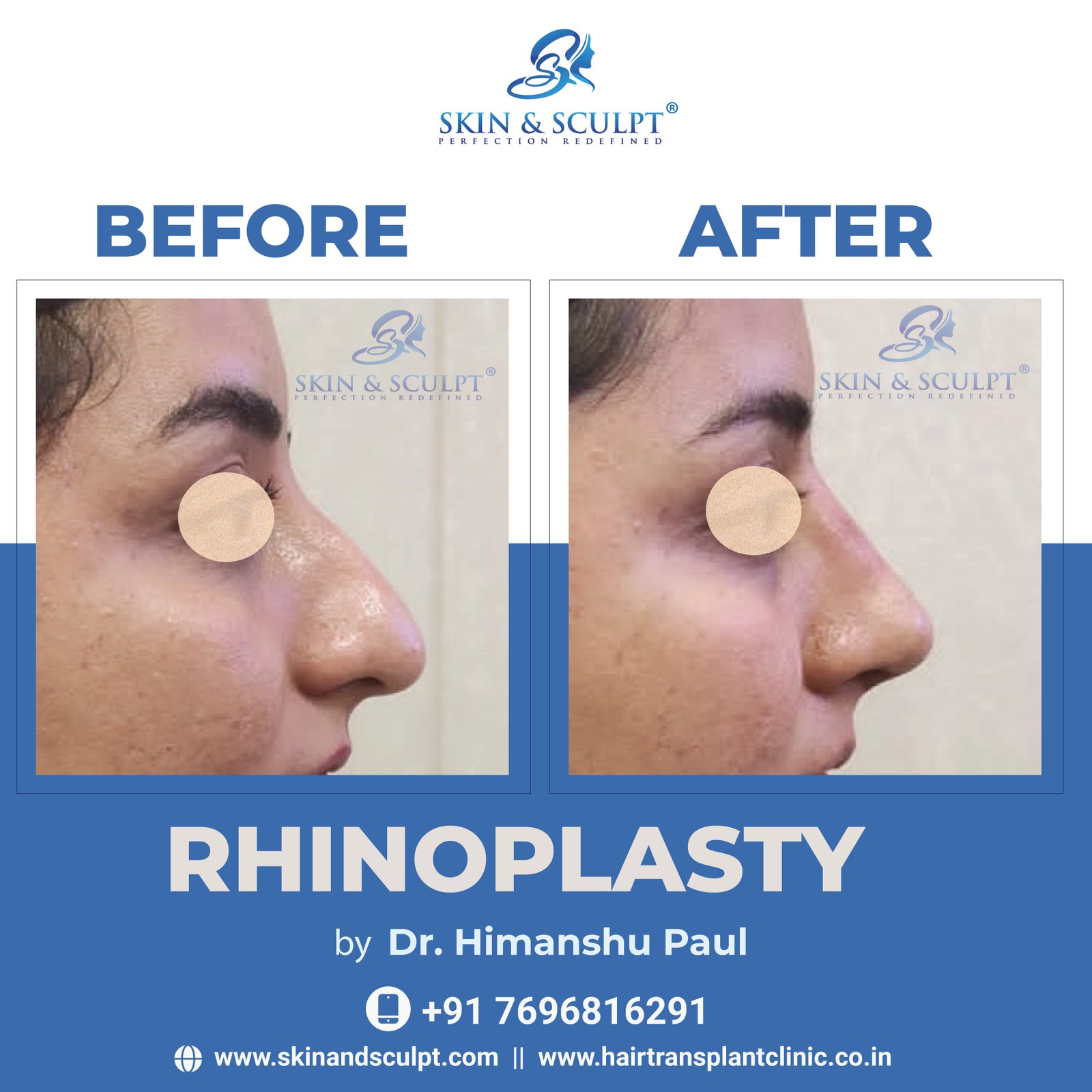 You are currently viewing  Rhinoplasty: A Guide to Choosing the Right Surgeon and Understanding the Procedure