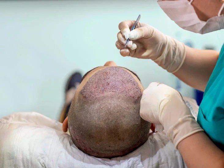Read more about the article Can Hair Transplant Produce Long Lasting Results?