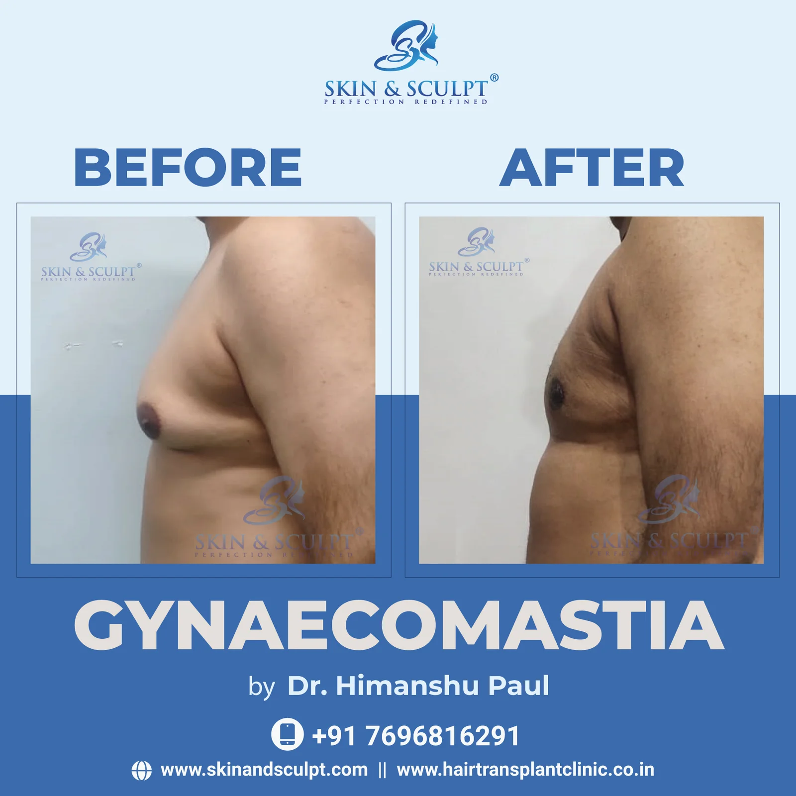 You are currently viewing Factors That Influence Gynecomastia Surgery Results