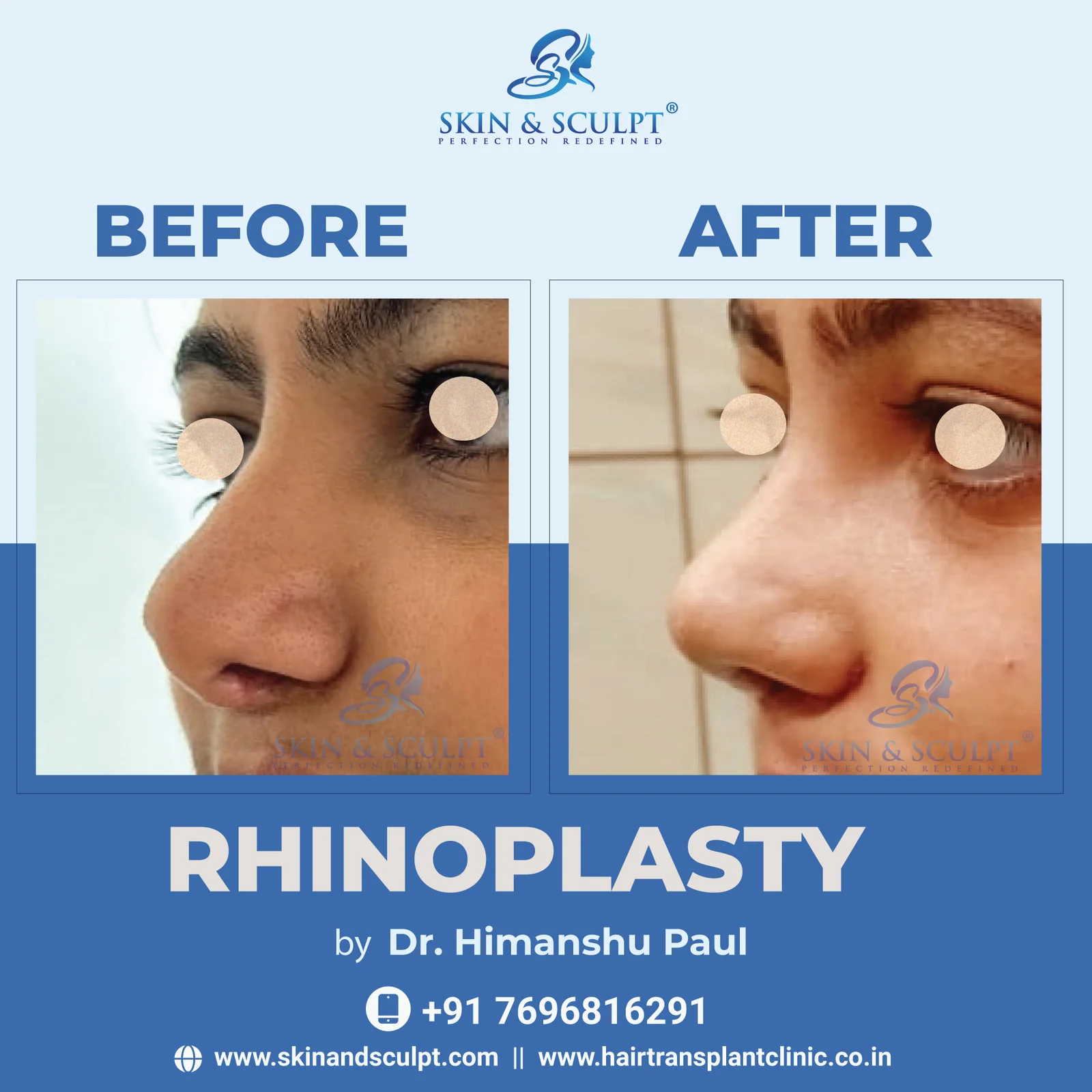 Read more about the article Rhinoplasty Surgery: What to Expect Before, During and After