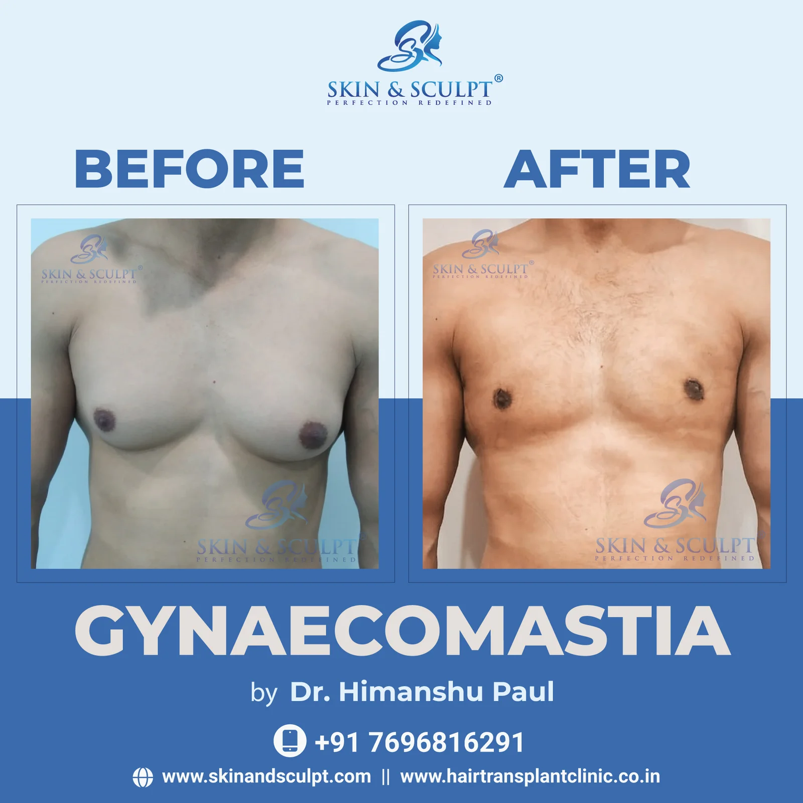 Read more about the article Gynecomastia Treatment in Chandigarh: Reflections in Pop Culture